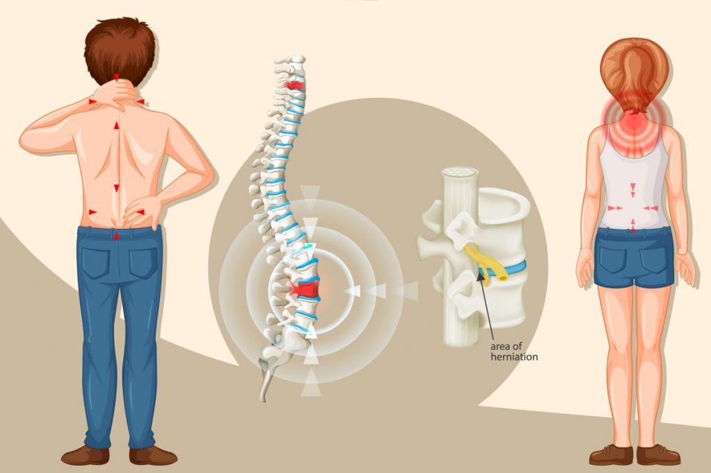 Para combatir la causa de los problemas de espalda tenemos que buscar una solución que regenere los tejidos internos.