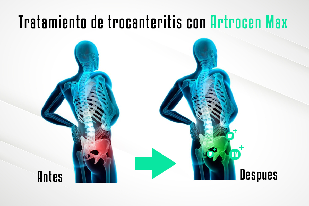 Artrocen MAX Remedio natural para la artrosis